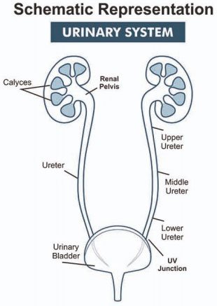 Small Kidney Stones Cause Severe Pain Small Kidney Stones Cause Severe Pain