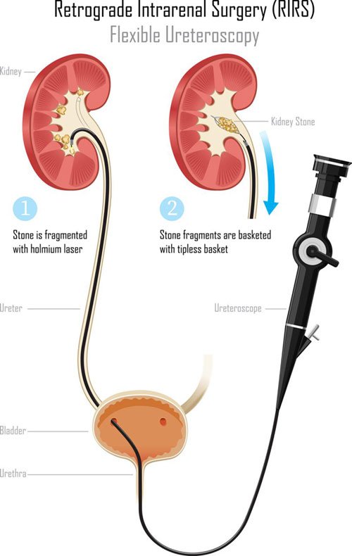 RIRS Surgery RIRS Surgery