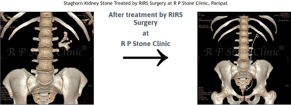 At R P Stone Clinic, even selected staghorn kidney stones are treated using RIRS surgery