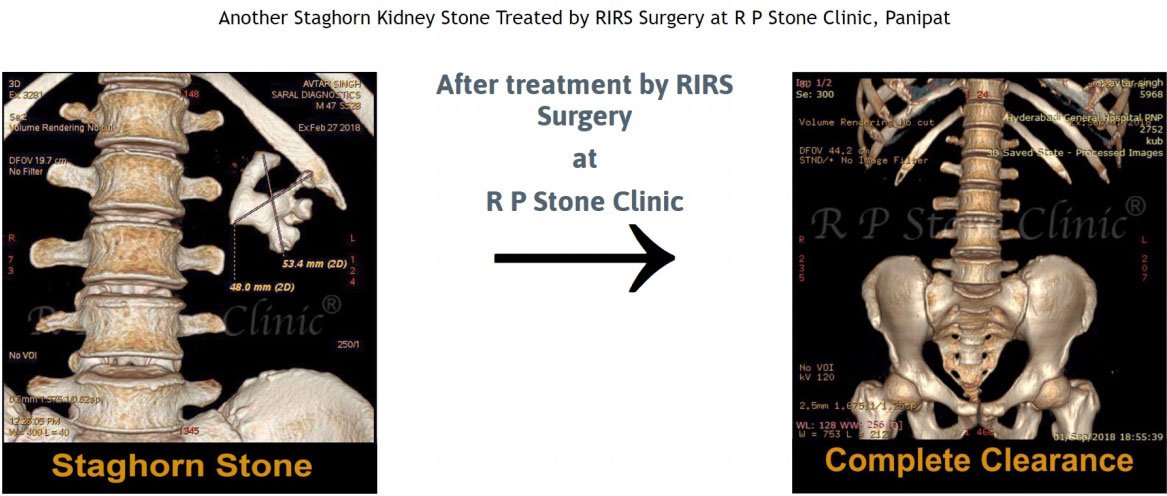 At R P Stone Clinic, even selected staghorn kidney stones are treated using RIRS surgery